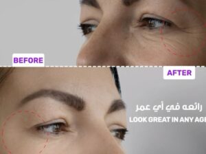Botox for removing fine details of lines and wrink