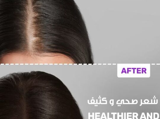 لعلاج تساقط الشعر lc hair تقنية