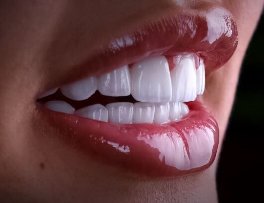 ابتسامة ايليت ابتسامة مثالية