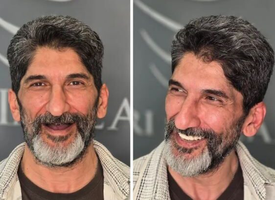زراعة الأسنان الفورية